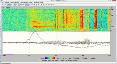 Neuromonitoring solution image 10